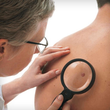 Exames preventivos do câncer da pele